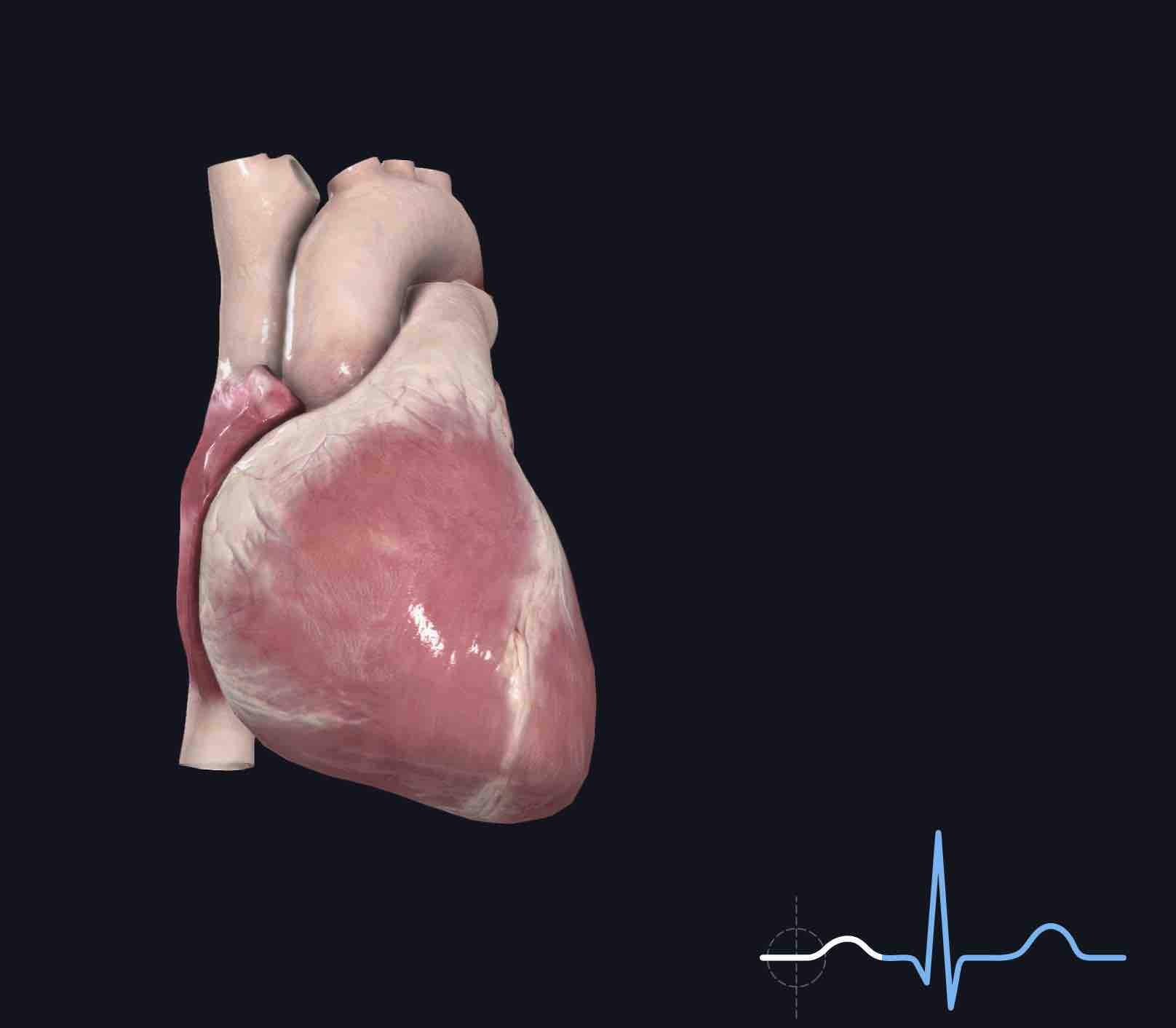 射频热凝适用于治疗患有心脏病的三叉神经痛患者